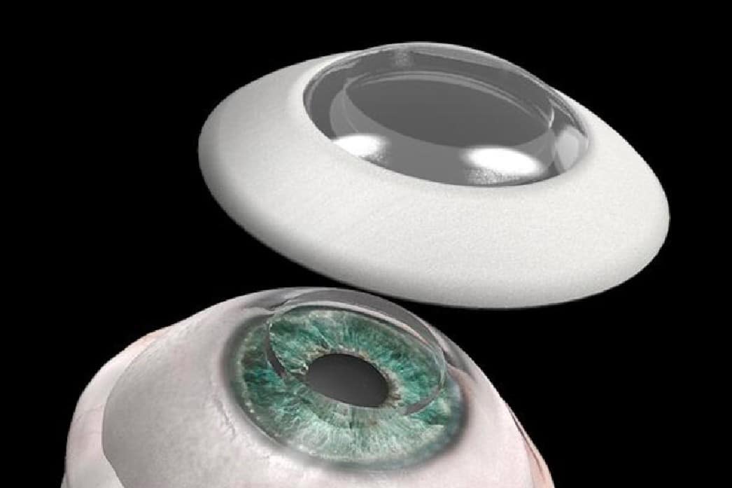 blinde man kan weer zien kunstmatig hoornvliesimplantaat CorNeat Vision KPro